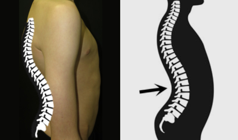 Pectoralis Spasm Due to Poor Posture — Restore353