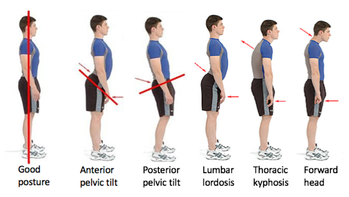 Comparison of normal and pectus posture Royalty Free Vector