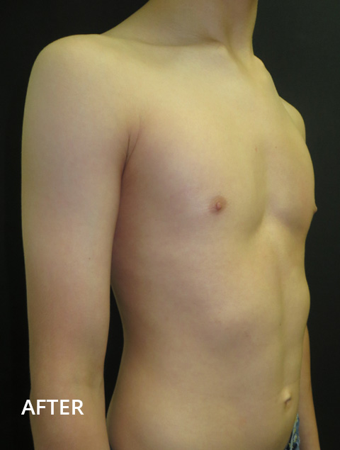 What to know about bracing for Pectus carinatum