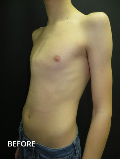 Pectus Deformity FAQs: How visible is the chest brace under clothing? 