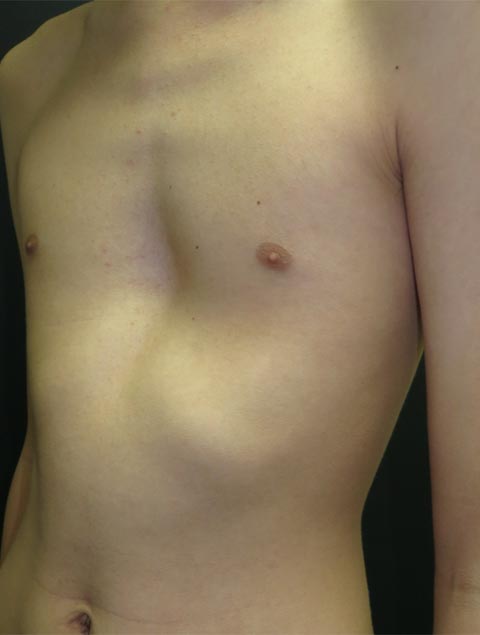 Bowed chest (pigeon breast): MedlinePlus Medical Encyclopedia Image