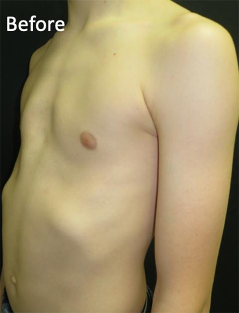 Hospital offers non-surgical treatment for chest-wall deformity