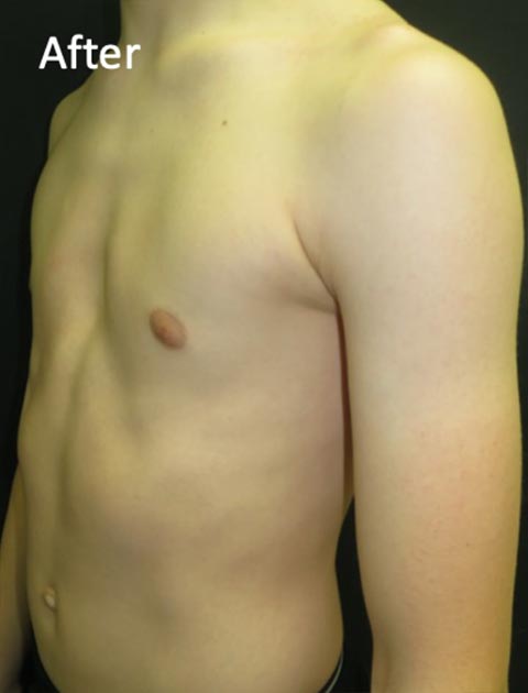 What to know about bracing for Pectus carinatum
